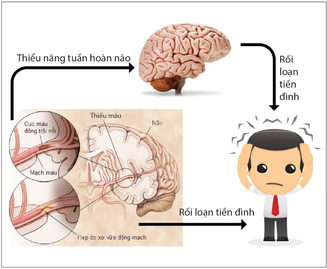 Rối Loạn Tiền Đình là gì? Sự thật không ai nói? | Ths Bs Nguyễn Thành An Official - YouTube